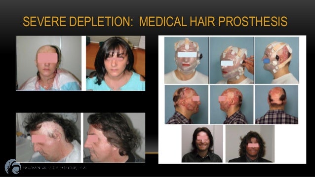 Welcome To Advanced Hair Solutions Hair Loss Advisors | image gallery hair prosthesis Welcome To Advanced Hair Solutions Hair Loss Advisors | image gallery hair prosthesis